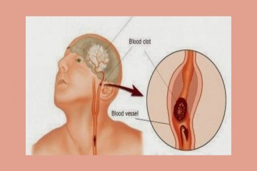 ΕΓΚΕΦΑΛΙΚΟ