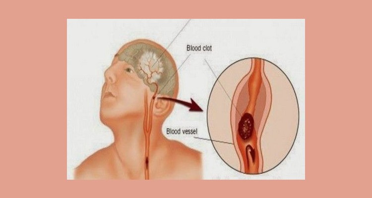 ΕΓΚΕΦΑΛΙΚΟ